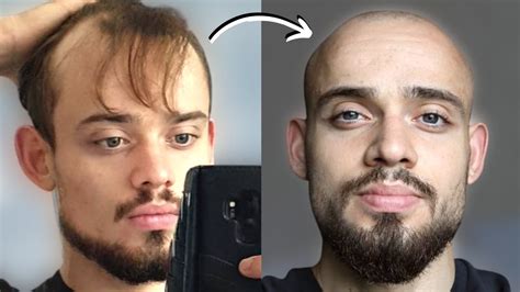 100 balding men before after shaving head bald 2 youtube