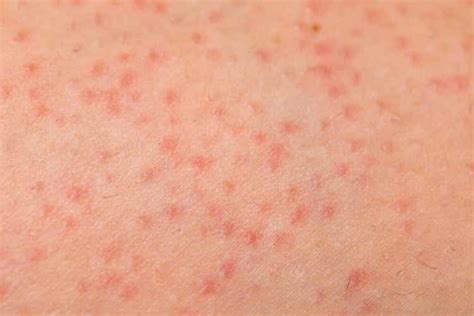 Keratosis Pilaris In Children Symptoms Causes And Treatment You Are Mom