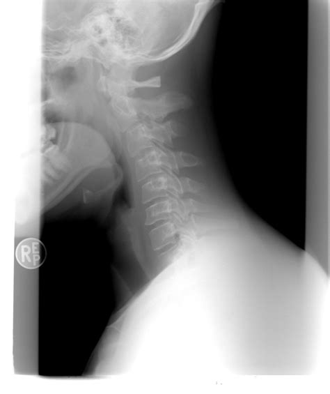 Rachis Cervical Radiographie Photo Gratuite Sur Pixabay