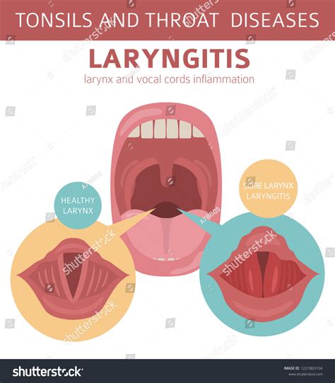 Tonsils Throat Diseases Laryngitis Symptoms Treatment Vector Có Sẵn