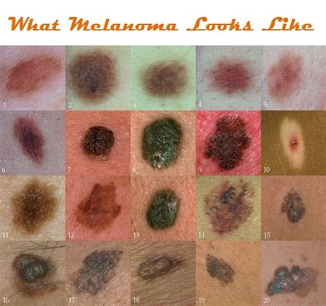 He will also know and do what needs to be done to make the situation better without you having to ask. Pin on Melanoma