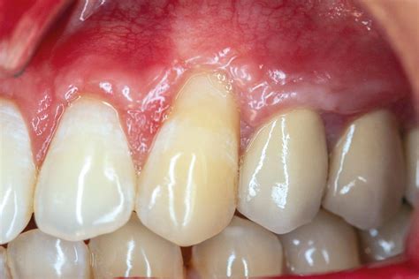 Treatment Of Single Gingival Recession With Mucoderm Dr A Hamdy