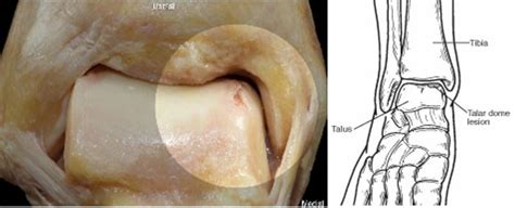 Osteochondral Lesion Of The Talus Sportsfit Physio And Health