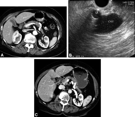 Long Term Follow Up Of Pancreatic Cysts That Resolve Radiologically