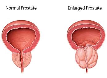 Reviews common tests for these conditions, as well as treatment side effects. Prostate Gland Enlargement: How It Affects Your Life and ...