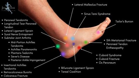 Foot Pain Chart Top Of Foot Side And Front Of Foot Pain Chart