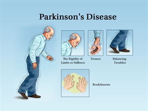 What Is Parkinsons Lets Understand With A Complete Guide