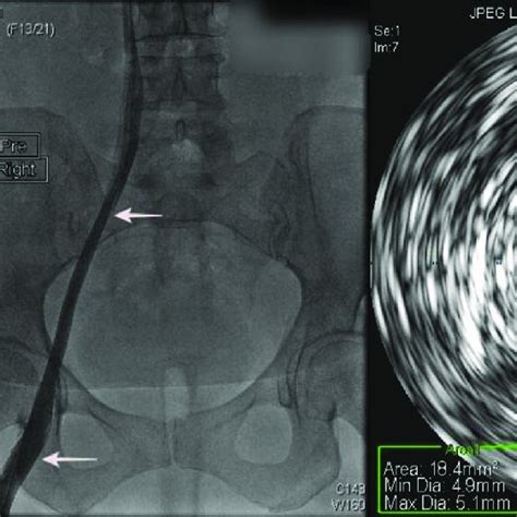 Extreme Examples Of Rokitansky Stenosis Are Easily Recognized Left