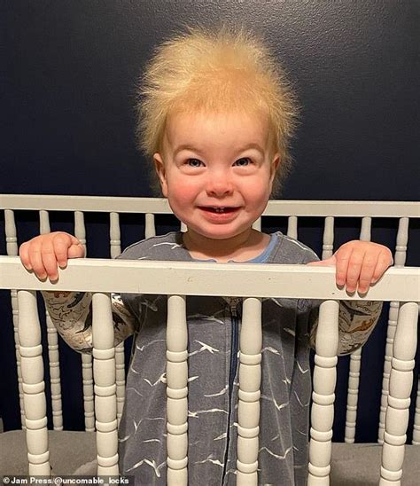 One Year Old With Rare Uncombable Hair Syndrome Daily Mail Online