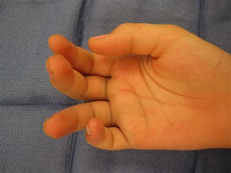 Less Invasive Finger Fracture Treatment John Erickson Md