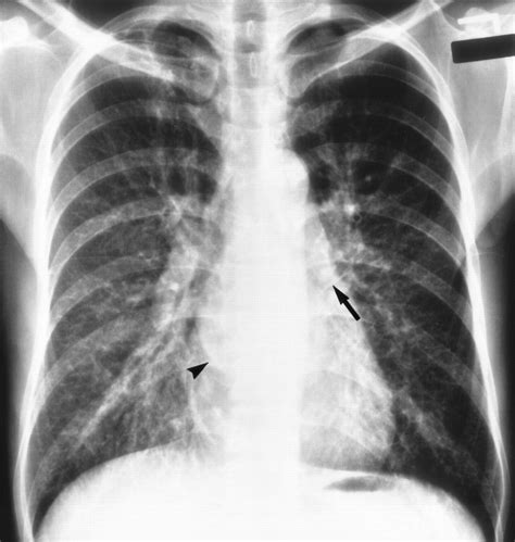 Pulmonary Parenchymal Manifestations Of Mitral Valve Disease