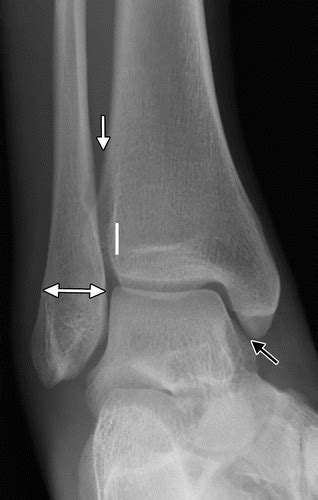 Normal Ankle Xray Ap