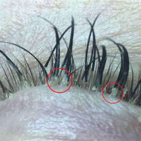 Eyelash Mites The Truth About Eyelash Extensions With Pictures