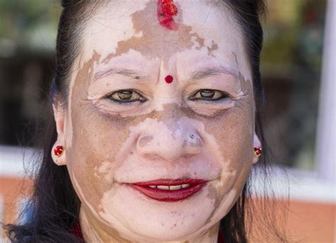 Vitiligo Symptoms Causes And Treatments