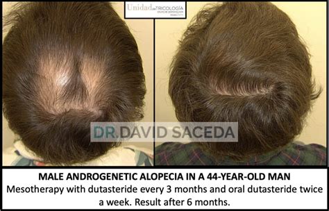 Doctor David Saceda Dermatólogo Tricólogo Alopecia Trasplante