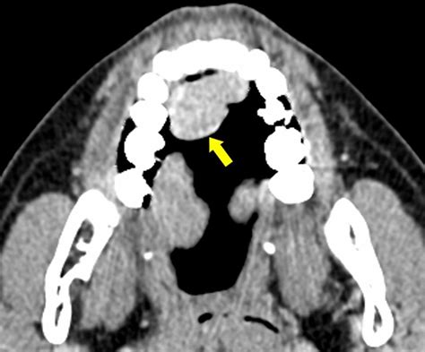 Contrast Enhanced Ct Showed Heterogeneous Enhancement Within The
