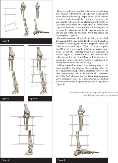 Figure 2 From Circular External Fixator Application For Midshaft Tibial