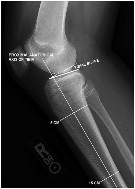 Measurement Of Posterior Tibial Slope On Lateral Radiograph The