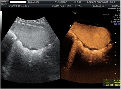 Figure1 Contrast Enhanced Voiding Ultrasonography Bladder Filled With