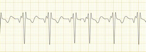Ads Ecg Waveform Not Stable Getting Inverted Qrs Complex