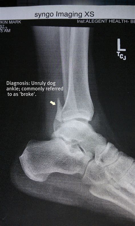 His bones appear only because electrocution makes your bones visible cliché and x ray more likely shows parts of laser and heat producing system in his legs rather than his bones. 1000+ images about broken ankle on Pinterest | Ankle ...