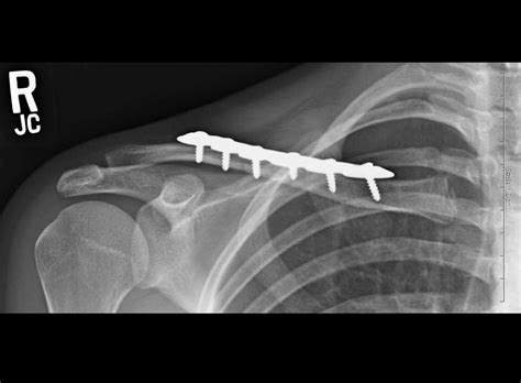 Clavicle Fracture Surgery Shoulder Surgeon Santa Barbara Santa