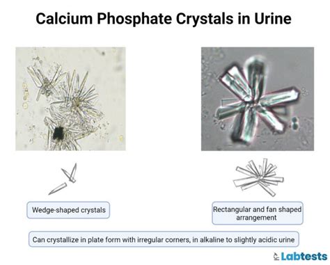 Urinary Crystals Types Causes And Clinical Significance