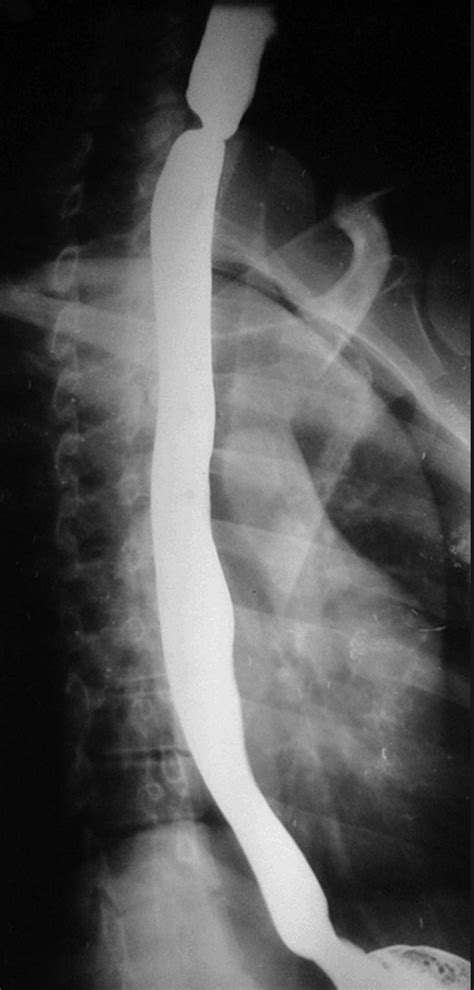 أبطال الكرة الفرسان الحلقة 41 مدبلجة للعربية و بجودة عالية و بشاشة كاملة. Plummer-Vinson / Plummer Vinson Syndrome Foundations Osmosis : This name comes from two ...