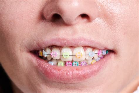 Macro Snapshot Of White Teeth And Ceramic Braces With Colorful Rubber Bands On Them Beautiful