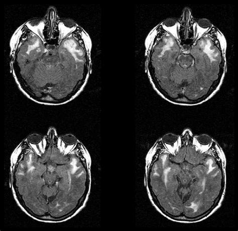Hereditary Cerebral Small Vessel Diseases A Review Journal Of The