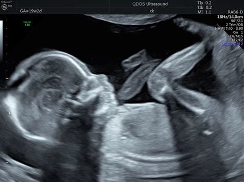 19 Week Scan Perth Mid Trimester Ultrasound Pregnancy Scan Perth