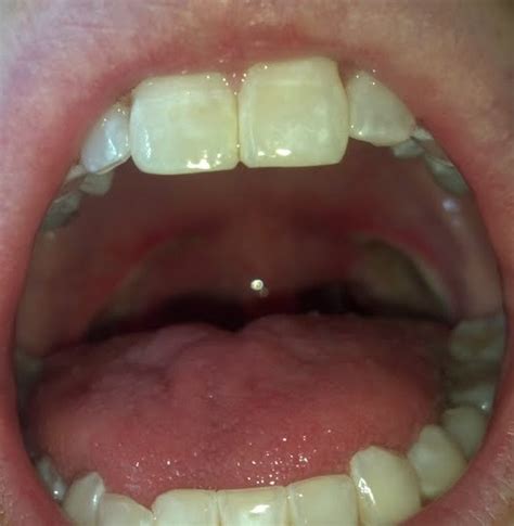 Anne And Brandons Blog Tonsillectomy Post Op Updates