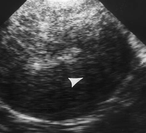 Sonographic Findings In Patients With Adenomyosis Can Sonography