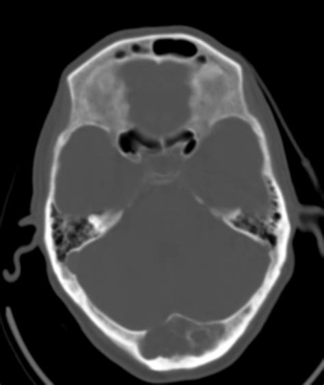 Intradiploic Epidermoid With Intracranial Extension Sumers Radiology