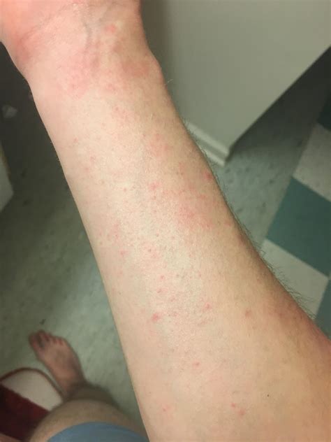 Why Does My Eczema Suddenly Look Like Chicken Pox Eczema
