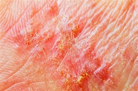 What Does Eczema Look Like 5 Signs To Never Ignore Readers Digest