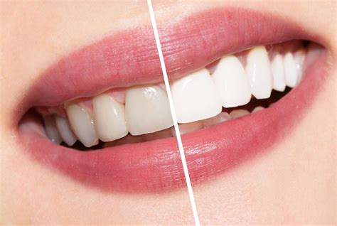 Teeth Whitening Guernsey Book Today For Whiter Teeth