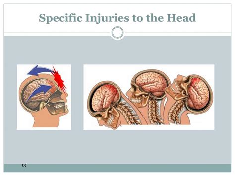 Ppt Head Neck And Spine Injuries Powerpoint Presentation Free