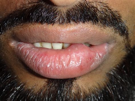 Soft Fluctuant Swelling On Lower Lip Extra Oral View Download