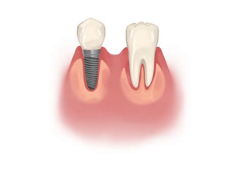 What Are The Signs Of Dental Implants Failure Authority Dental