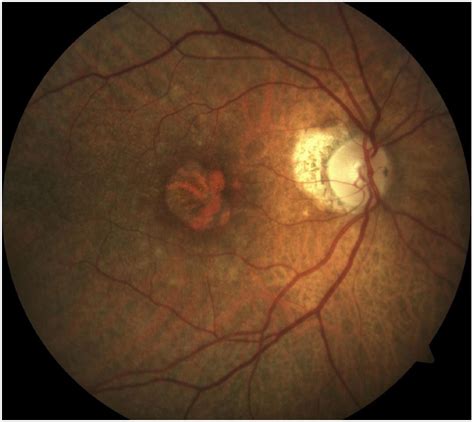 Round Patch Of Central Ga Involving The Center Point Of The Macula