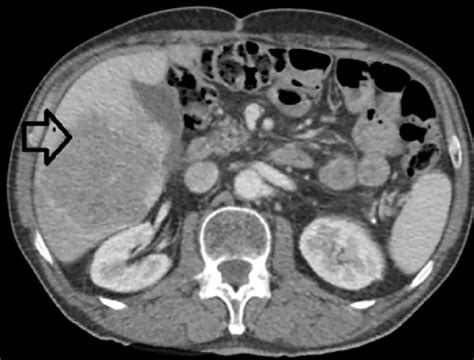 Cureus Resection Of Large Metachronous Liver Metastasis With Gastric