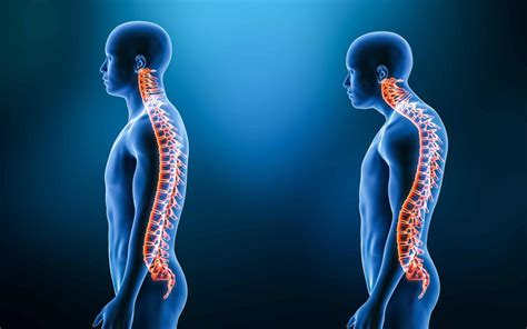 Understanding Kyphosis Causes Symptoms And Treatments Becker Spine