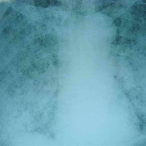 Chest Radiograph Demonstrating Diffuse Bilateral Pulmonary Infiltrates