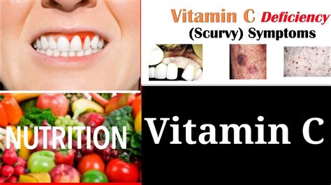 Vitamin C Scurvy Disease Deficiency Symp Of Vitamin C Nutrition Part