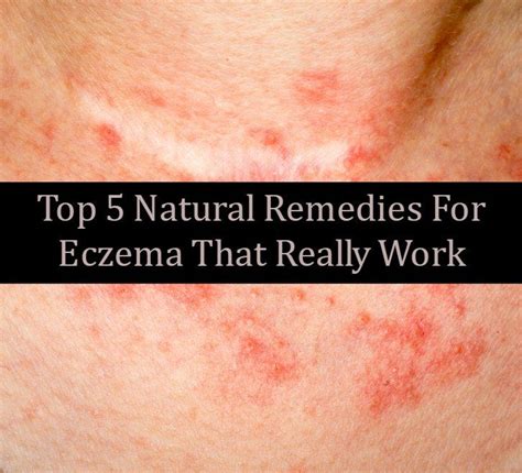 13 Home Remedies To Get Rid Of Eczema That Really Work Natural Eczema