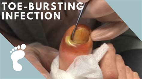 Oozing Pus Infected Ingrown Youtube