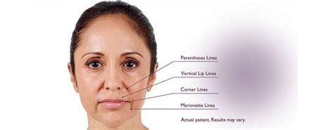 Aesthetic Hyaluronic Acid Injection Filling Of The Nasolabial Folds
