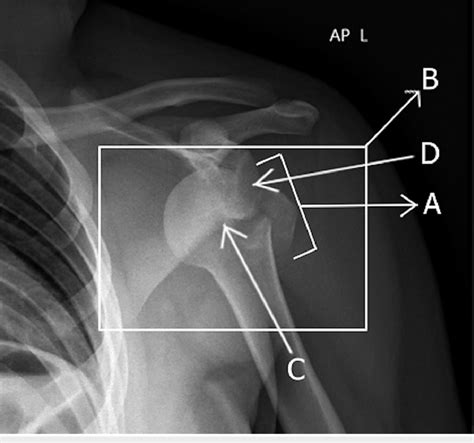 Anterior Posterior X Ray Showing The Anterior Left Glenohumeral Joint