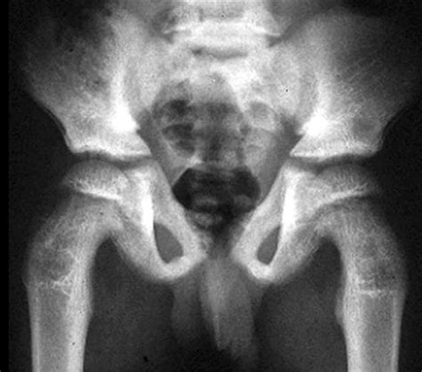 Skeletal Fluorosis Wikidoc